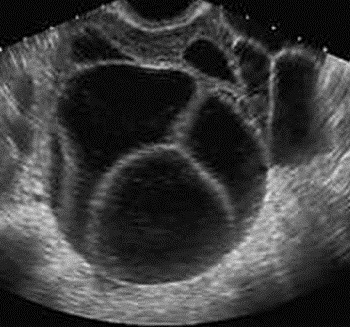 ¿Qué significa tener un embarazo molar?