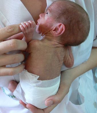 Complicaciones que debe afrontar un bebé prematuro