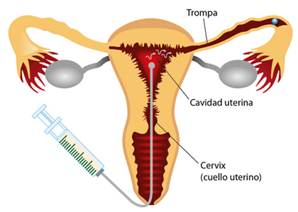 Los riesgos que tiene la inseminación artificial