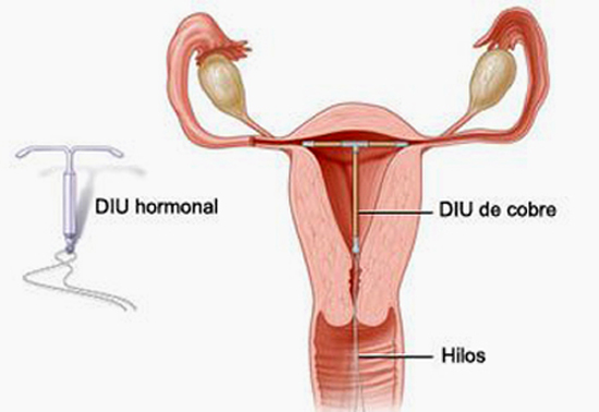 ¿Puedo quedar embarazada con un DIU?