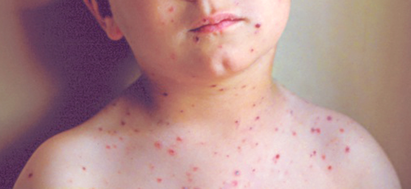 ¿Cuáles son las enfermedades exantemáticas en la infancia?