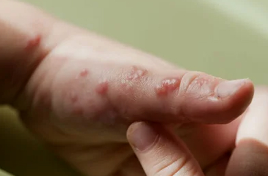 Causas, sintomas y tratamiento del herpes infantil