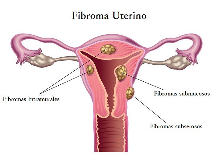 Fibroma-uterino