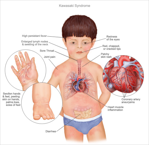 La enfermedad de Kawasaki